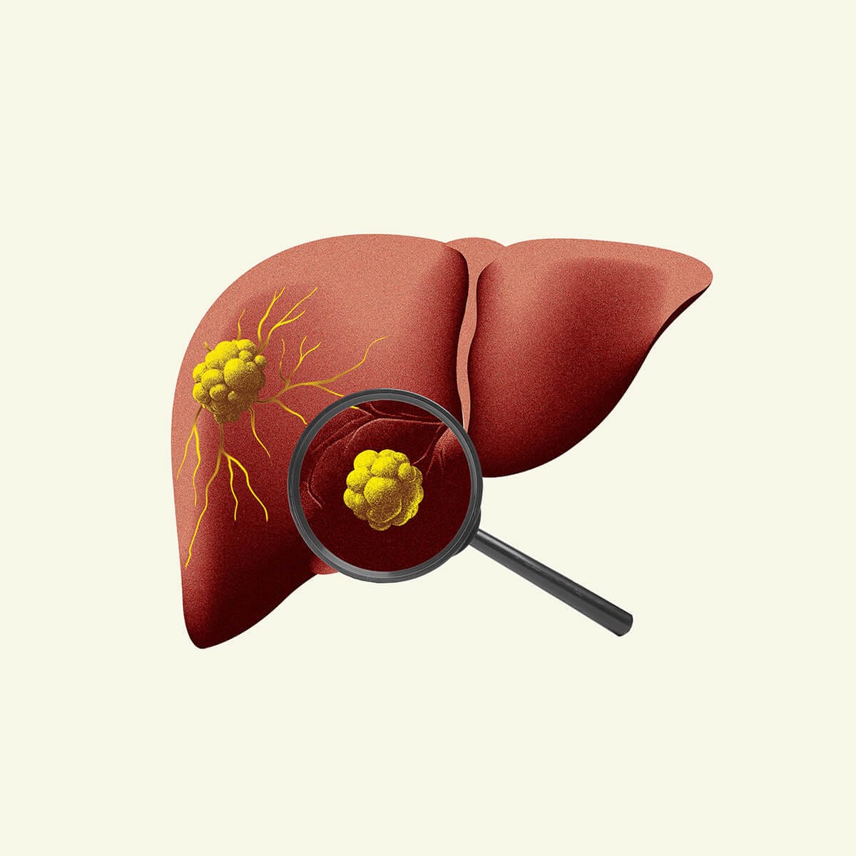 Cum îți afectează alcoolul ficatul (adesea fără să știi)